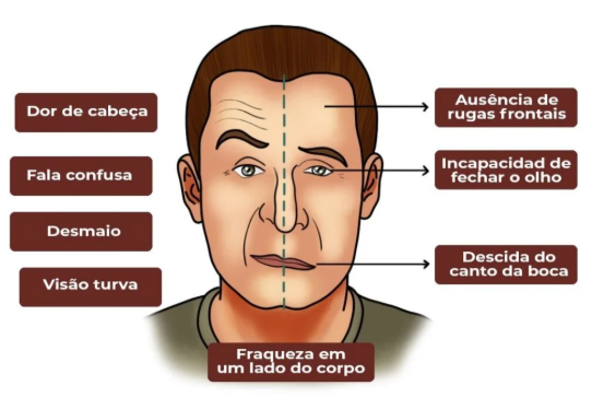 sintomas avc